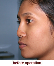 plastic_surgery_augmentation_rhinoplasty